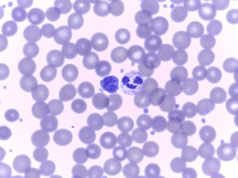 A blood smear specimen at the Petersburg lab shows lymph and mature netrophil. (Photo courtesy of Liz Bacom)