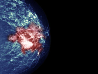 By testing tumors, researchers hoped to identify women who could avoid chemotherapy without increasing their risk of a cancer recurrence. (Image by Voisin/Phanie/Science Source)