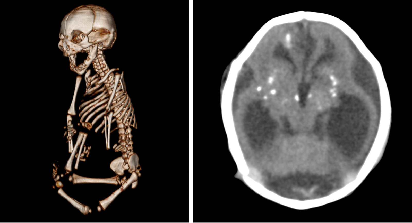 Zika infections during gestation can damage other parts of the body besides the brain. In this case, the baby was born with severe stiffness in the joints, which keeps the baby from straightening arms and legs normally. The baby's brain shows the telltale sign of an infection: white dots called calcification. (Photo courtesy of the Radiological Society of North America)