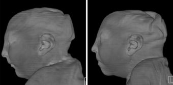 Twin girls born with extremely small heads, shrunken spinal cords and extra folds of skin around the skull. Scientists think this skin forms when the skull collapses onto itself after the brain — but not the skull — stops growing. The images of the girls' heads were constructed on the computer using CT scans taken shortly after birth. The girls were infected with Zika at 9 weeks gestation. (Courtesy of the Radiological Society of North America)