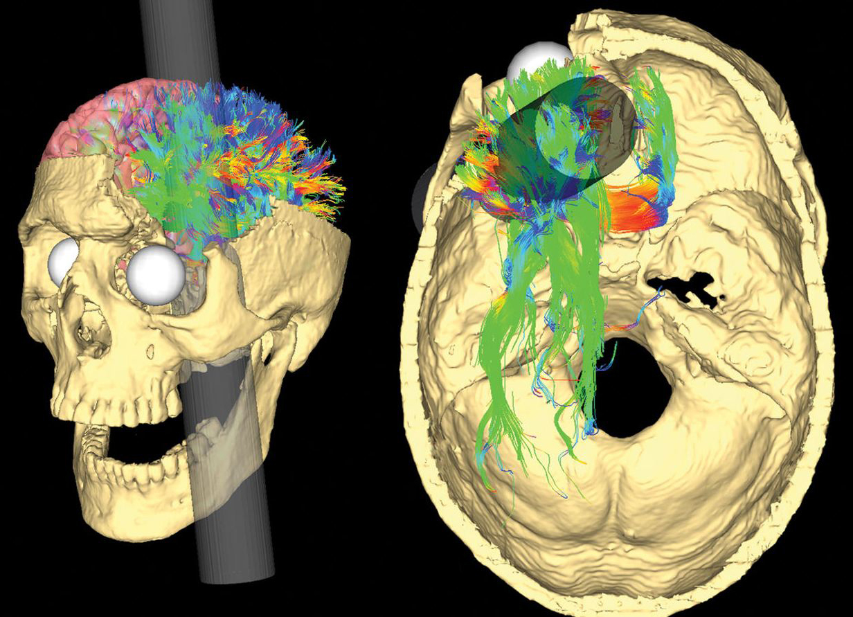 Two renderings of Gage's skull show the likely path of the iron rod and the nerve fibers that were probably damaged as it passed through.
