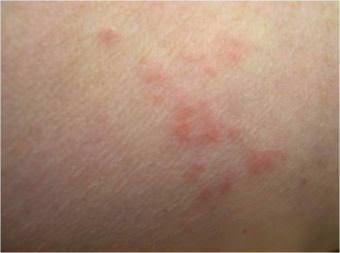 A person's arm with bed bug bites