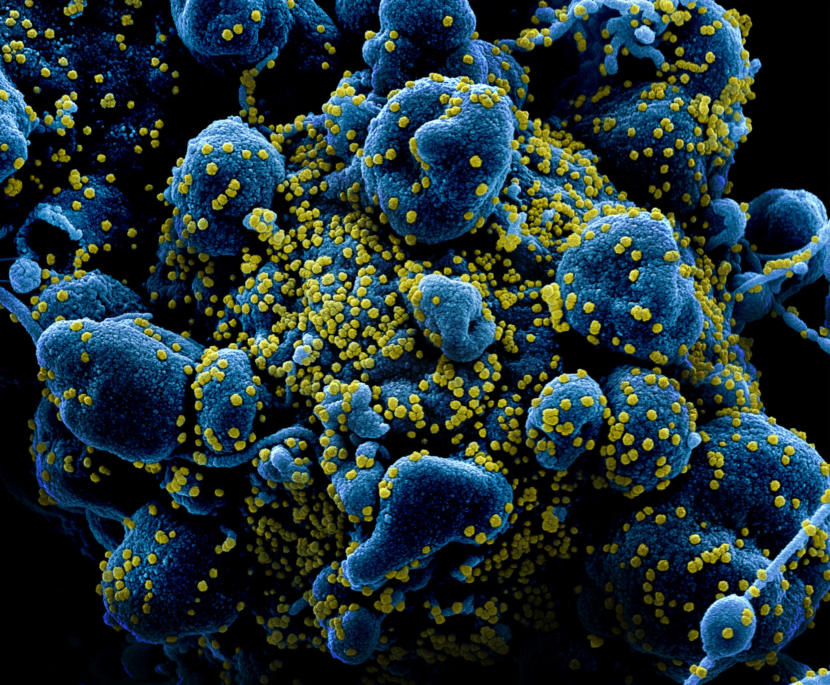 Colorized scanning electron micrograph of an apoptotic cell (blue) heavily infected with SARS-COV-2 virus particles (yellow), isolated from a patient sample. Image captured and color-enhanced at the NIAID Integrated Research Facility (IRF) in Fort Detrick, Maryland. Credit: NIAID