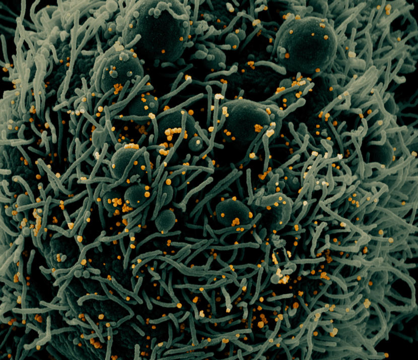 Colorized scanning electron micrograph of an apoptotic cell (green) infected with SARS-COV-2 virus particles (orange), isolated from a patient sample. Image captured at the NIAID Integrated Research Facility (IRF) in Fort Detrick, Maryland. Credit: NIAID