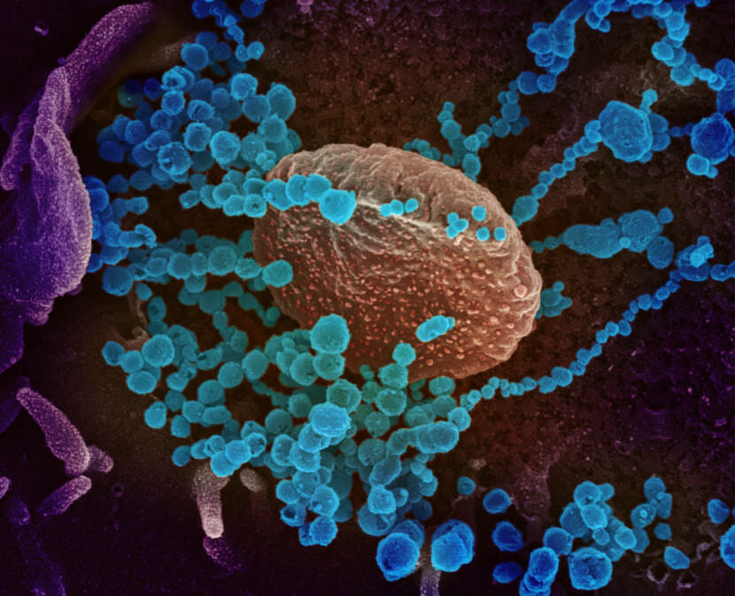 Transmission electron micrograph of SARS-CoV-2 virus particles, isolated from a patient. Image captured and color-enhanced at the NIAID Integrated Research Facility (IRF) in Fort Detrick, Maryland. (National Institute of Allergy and Infectious Diseases)