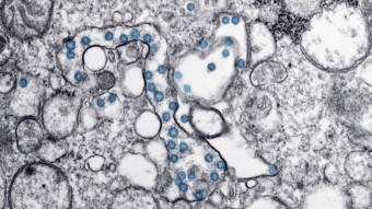 coronavirus particles microscope image