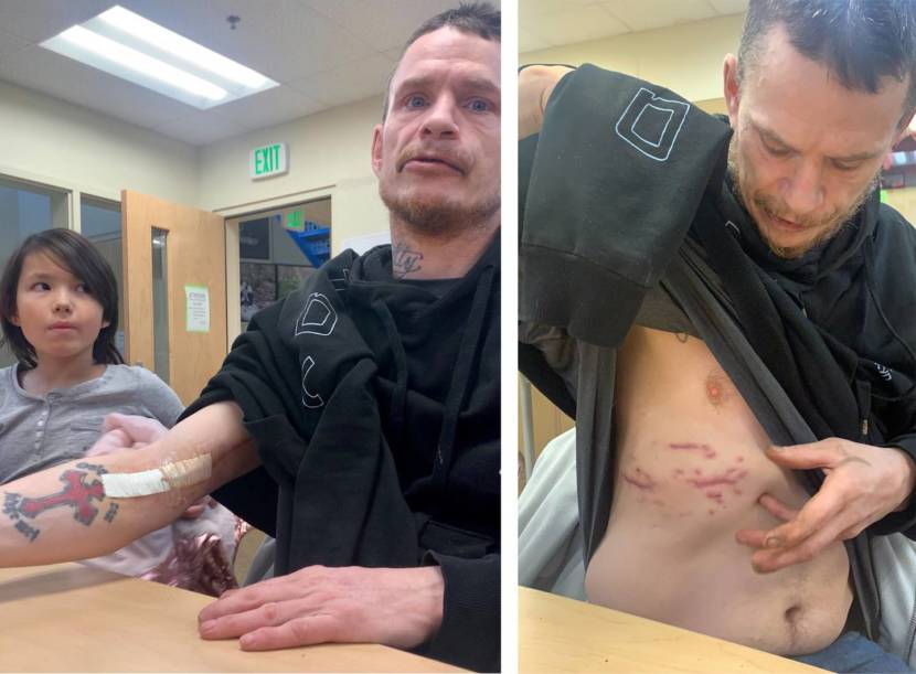 A man pulls up his shirt to reveal the recently healed scars from shotgun pellets